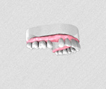 Remplacer une dent