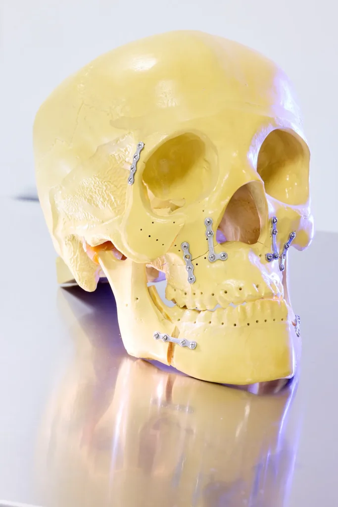 Modèle anatomique de crâne avec plaques d'ostéosynthèse